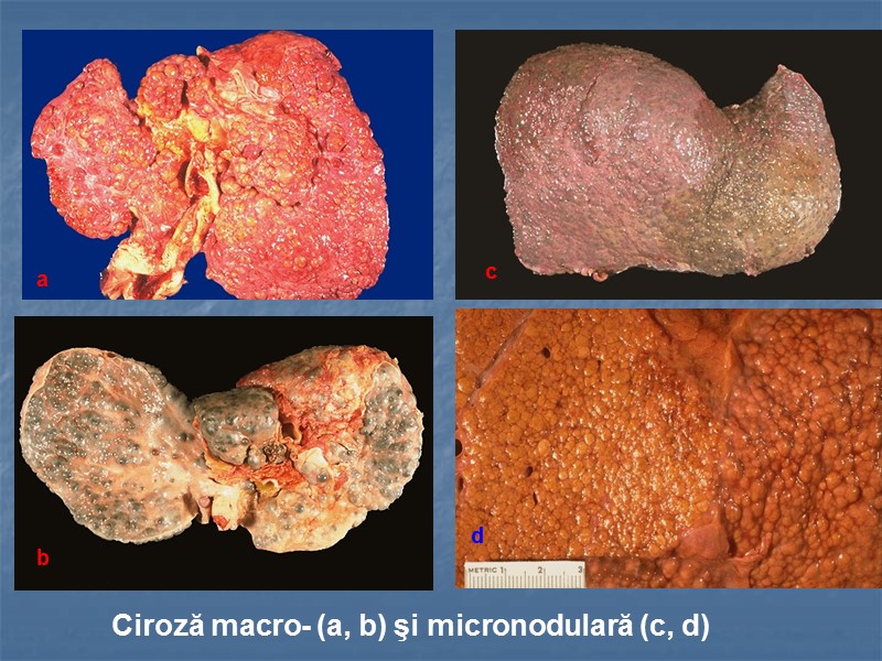 Ciroză macro- (a, b) şi micronodulară (c, d) a b c d